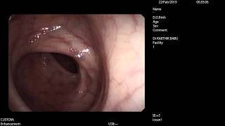 Typhilitis - Isolated caecal ulcer on colonoscopy