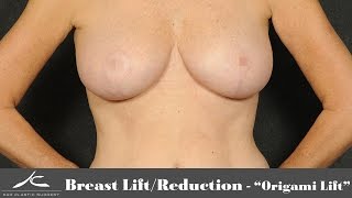 Breast Lift/Reduction - "Origami Lift"