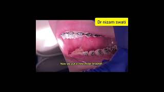 how to take dental braces