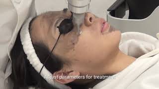 P ND yag laser carbon peeling operation