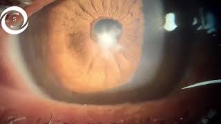 Ophthalmic Signs Cornea