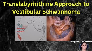 244. Translabrynthine Approach to Vestibular Schwannoma #surgeryeducation