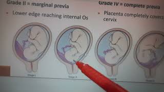 Placenta Previa | Obstetrics