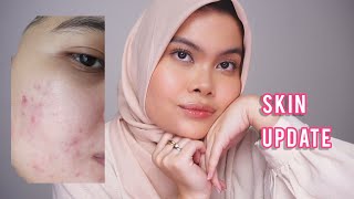 Skincare Jerawat, Differin, Olahraga | Skin Update 2023