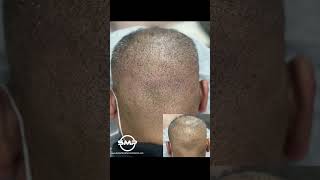 SMPCA - Bay Area hair loss services (510)258-9543 DM for a free consultation