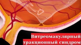 Витреомакулярный тракционный синдром (ВМТС) - клиника диагностики и лечения сетчатки глаза