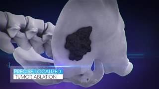 Introducing INSIGHTEC's Exablate for pain palliation of bone metastases