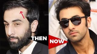 मामला Receding hairline regrowth|Ranbir Kapoor|Hair|Transplant|Minoxidil|Finasteride|Results|growth