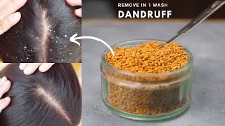 How To Get Rid of Dandruff Permanently Naturally and Fast in One Wash