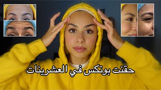 تجربتي مع حقن البوتكس في العشرينات + رأيي الشخصي في الحَقن+ My experience with Botox