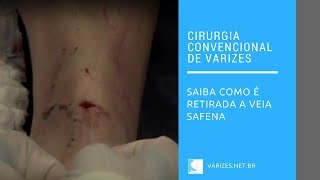 Cirurgia de varizes