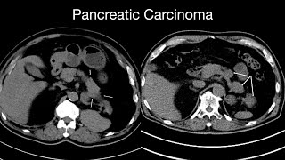 Pancreatic Carcinoma