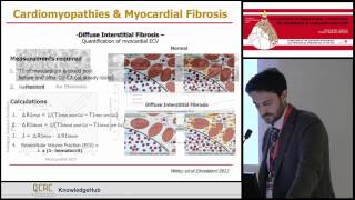 P G  Masci   Interstitial myocardial fibrosis detected by cardiovascular MRI as a subclinical marker of cardiac involvement in Imna   mutation carriers