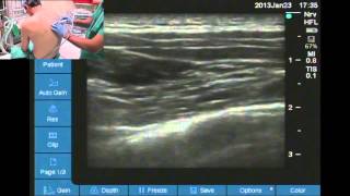 Ultrasound guided thoracic paravertebral space location