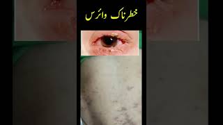 اپنے بچوں کو خطرناک وائرس سے بچائیں  #measles #healthtips