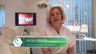 Görünmeyen Diş Teli Nedir? | Görünmeyen Diş Teli Tedavisi Nasıl Yapılır? | Dr. estethica