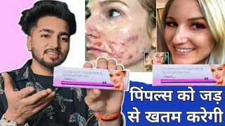 पिंपल्स को जड़ से खतम करेगी यह क्रीम | Clinsol Gel For Pimples, Acne, Blackheads Review