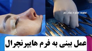 عمل بینی به فرم هایپرنچرال