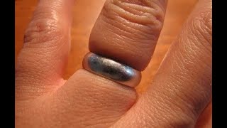 How to remove ring from swollen finger