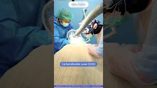 Carbondioxide Laser (Laser CO2) - Surabaya Skin Centre