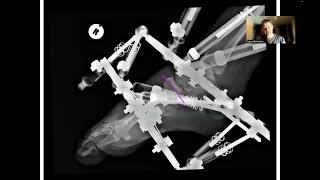 4 Limb reconstruction in the era of 3D printing