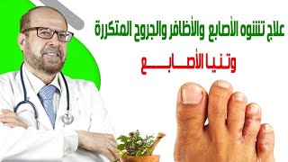 علاج تشوه الأصابع🎃 الأظافر🎃 والجروح المتكررة 🎃وتنيا الأصابع