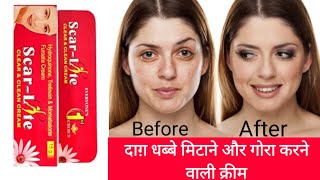 Scar lite cream review in hindi