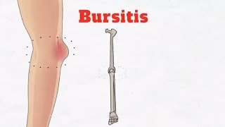 8 Tips For Preventing Knee Bursitis