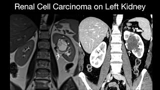 Renal Cell Carcinoma Case 17