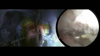 Arthroscopic Acromioclavicular Joint Reconstruction | Joint Injury | Colorado Shoulder Surgeon