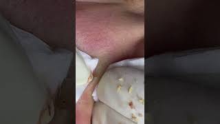 Big Cystic Acne Blackheads Extraction Blackheads & Milia, Whiteheads Removal Pimple Popping #shorts