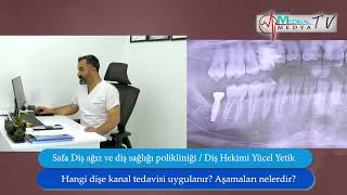 Kanal tedavisi nedir hangi durumlarda yapılır?