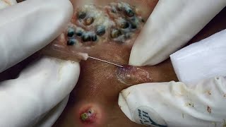 Big Cystic Acne Blackheads Extraction Blackheads & Milia, Whiteheads Removal Pimple Popping #035