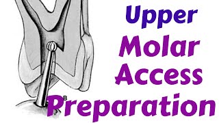 Upper Maxillary Molars - Endodontic  Access cavity Preparation -Endodontic Lecture & Tutorial