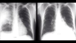 Recurrent bacterial pneumonia