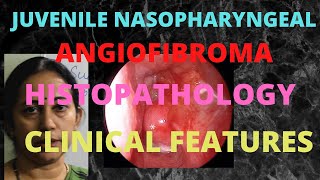 160.Juvenile Nasopharyngeal Angiofibroma Part3 #histopathology #clinicalexamination #jna