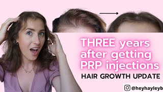 Does PRP help your hair grow?