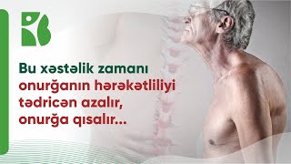 Bexterev xəstəliyi | Müalicə vaxtında başlanılmasa onurğa tamamilə hərəkətliliyini itirə bilər