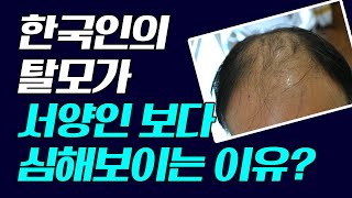 한국인의 탈모가 서양인보다 심해보이는 이유는?