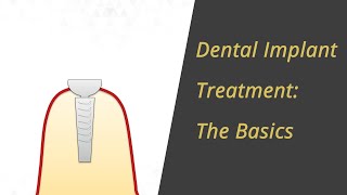 Basics of dental implant treatment