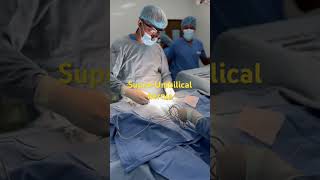 Supra-Umbilical hernia repaired by Dr. Mathula Hettiarachchi, paediatric surgeon in Kandy. 🩺👨‍⚕️