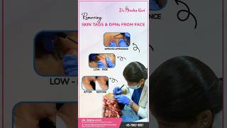 Say Goodbye to Skin Tags and DPNs from Face with Dr. Sneha Kovi