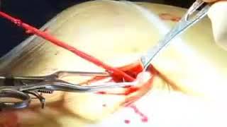 Coronary artery bypass surgery