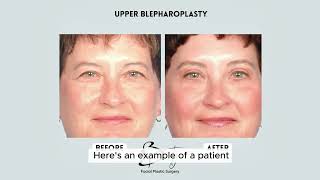 Blepharoplasty and Brow lift with Results Photos