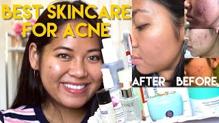 Best Skincare for Acne | Combination Skin