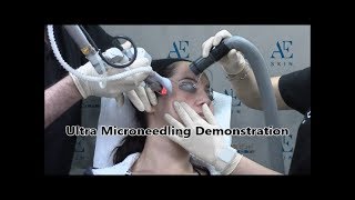 Ultra Microneedling Demonstration 10 - A E Skin - Encino, CA - 818-835-1833