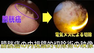 膀胱癌の実際の内視鏡切除術の動画です。解説つきの動画です。