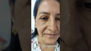 Toxina botulínica o Botox una excelente opción para arrugas del tercio superior #avefenixestetic