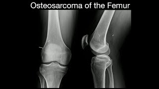 Osteosarcoma of the Femur