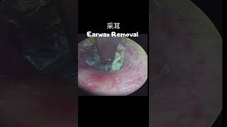 采耳 Earwax Removal #采耳 #earwax #earwax removal  #earwaxremove